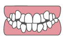 不正咬合｜叢生