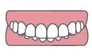 不正咬合｜過蓋咬合